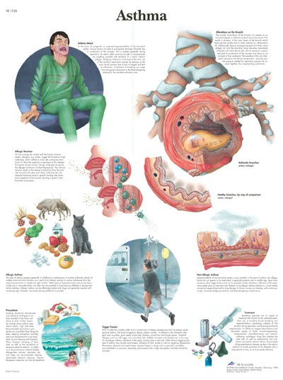 All Products - Wandkaart: Asthma